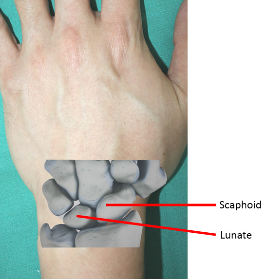 Radial-Sided Wrist Pain: The Scapholunate Ligament Injury - Mount