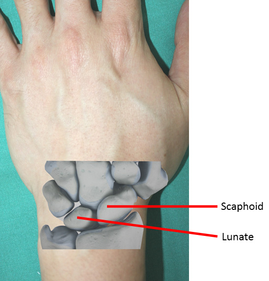 Coronary Ligament Sprain - Symptoms, Causes, Treatment