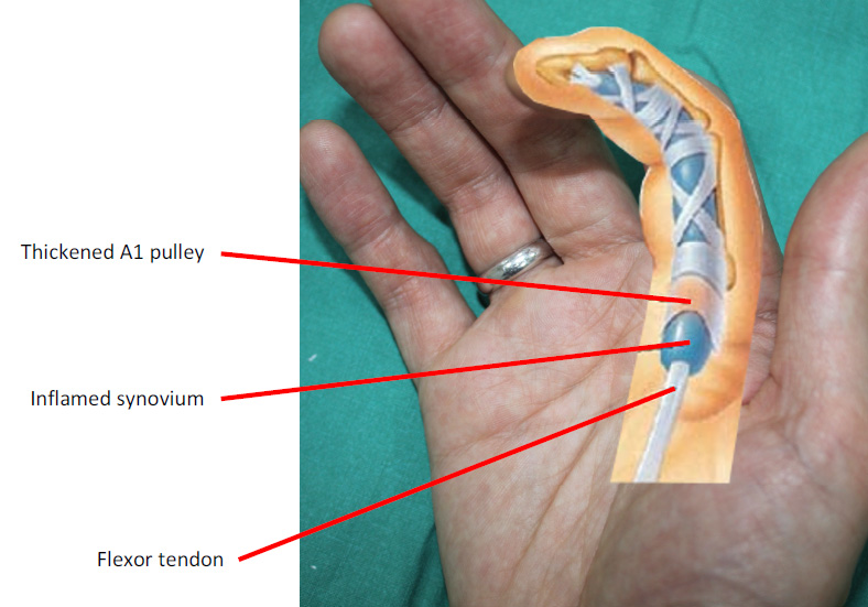 Trigger Finger or Trigger Thumb: Otherwise Known as Stenosing