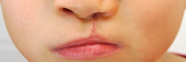 Cleft And Craniofacial Surgery At Mount Elizabeth Medical Centre Singapore