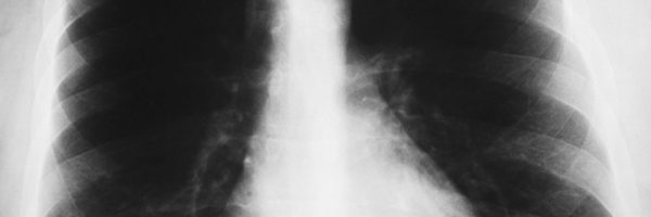 xray of a man's thorax