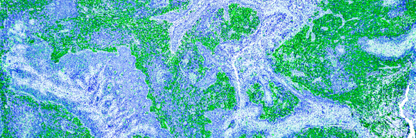 closeup of lymphoma cells